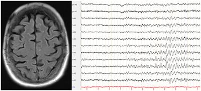 Plasmapheresis Responsive Rapid Onset Dementia with Predominantly Frontal Dysfunction in the Context of Hashimoto’s Encephalopathy